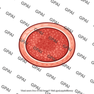 Thyroid adenoma