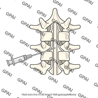 Total spinal anesthesia