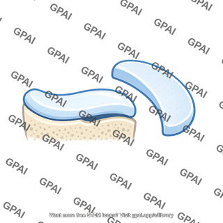 Articular cartilage displaced