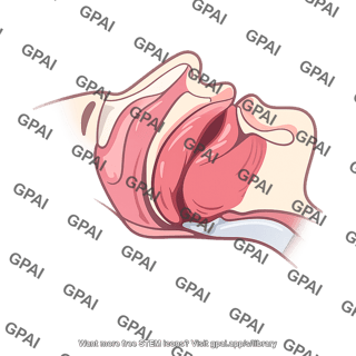 Obstructive sleep apnea airway