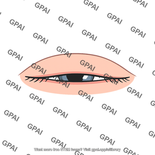 Eyelid incomplete closure