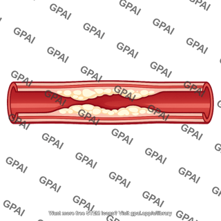 Atherosclerosis artery