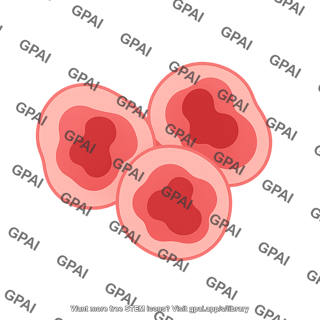 Ductal cell cancerous 2