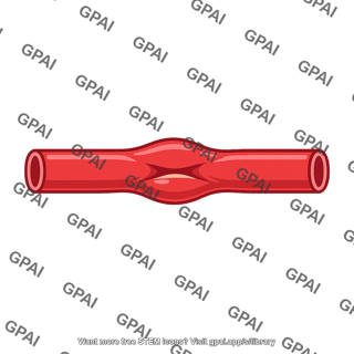 Artery aneurysm