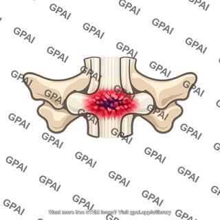 Spinal cord crush injury