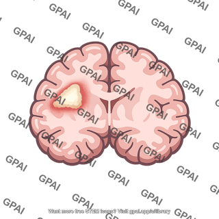 Brain infarct