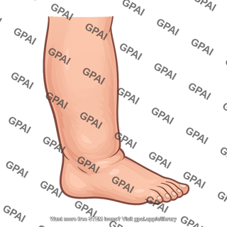 Leg edema