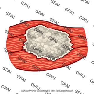 Infarcted heart tissue