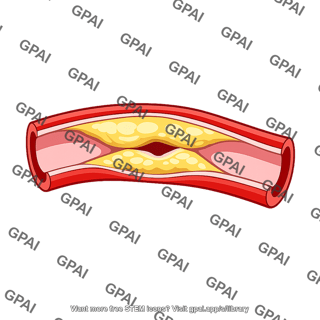 Coronary blood vessel blocked