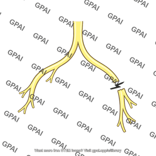Bundle branch block