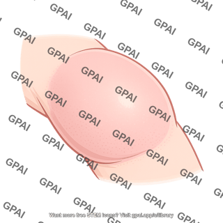 Edema nonpitting