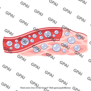 Decompression sickness