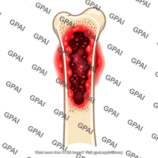 Osteomyelitis