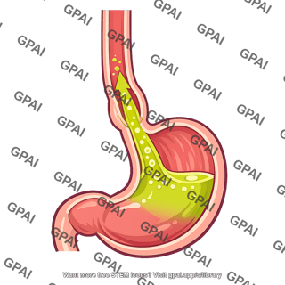 Gastroesophageal reflux
