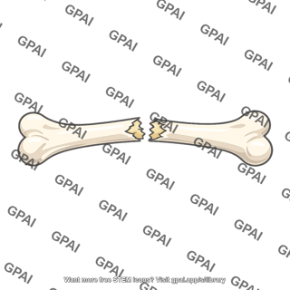 Long bone fractured