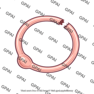 Semicircular duct damaged