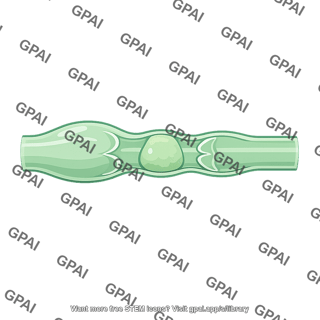 Lymphatic vessel obstructed