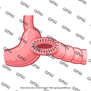 Gastrojejunostomy