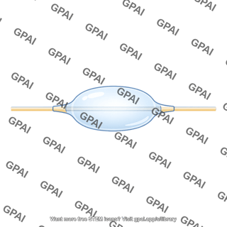 Balloon tipped catheter inflated