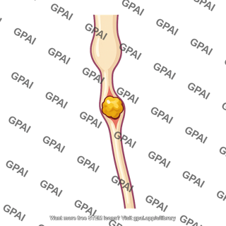 Ureter obstructed