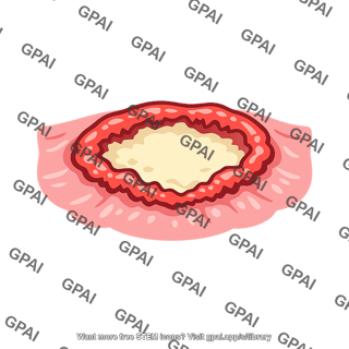 Colon ulcer