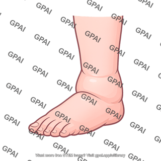 Peripheral edema