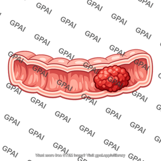 Colon cancer