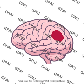 Stroke brain