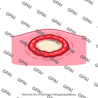 Ulcer