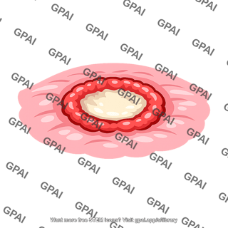 Peptic ulcer