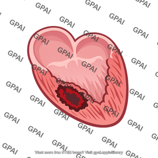 Infarcted ventricle area