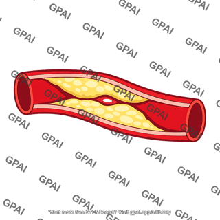Atherosclerosis artery
