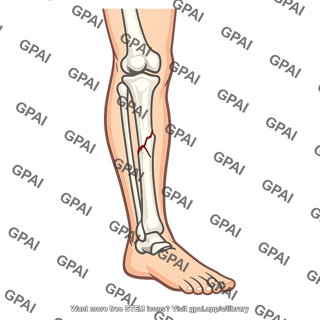 Leg fractured