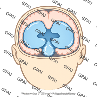Hydrocephalus noncommunicating