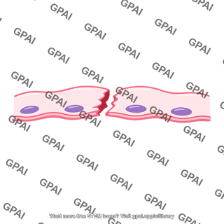 Alveolar epithelium ruptured