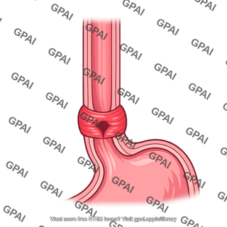 Lower esophageal sphincter
