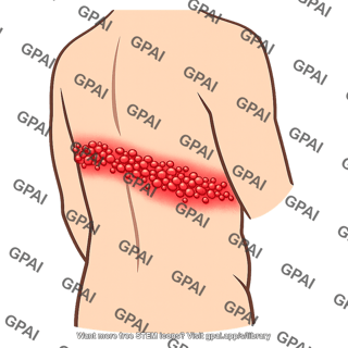 Shingles rash