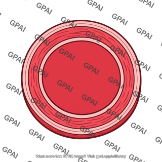 Blood vessel outward hypertrophic remodeling