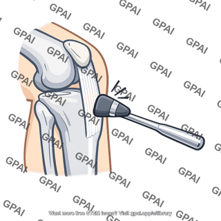 Patellar tendon struck