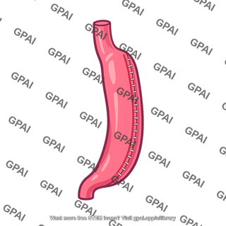Vertical sleeve gastrectomy stomach