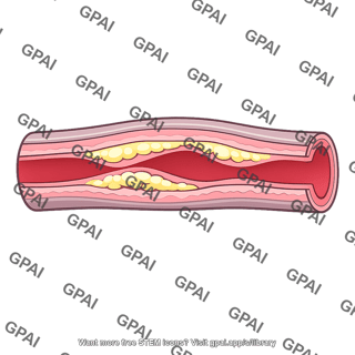 Arteriosclerosis