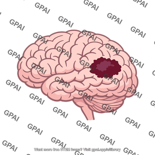Brain lesion