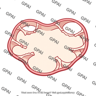 Alveolus emphysematous