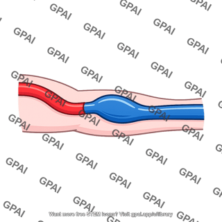 Hemodialysis fistula