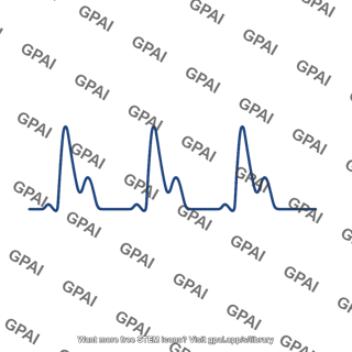 Right ventricular pressure curve