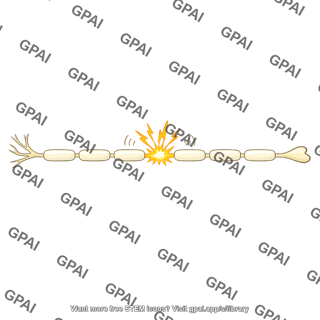 Nerve fiber spontaneously discharging