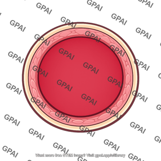Blood vessel outward remodeling
