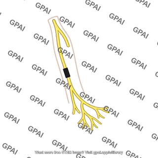 Left bundle branch blocked