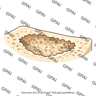 Area of bone resorption