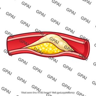 Atheromatous plaque